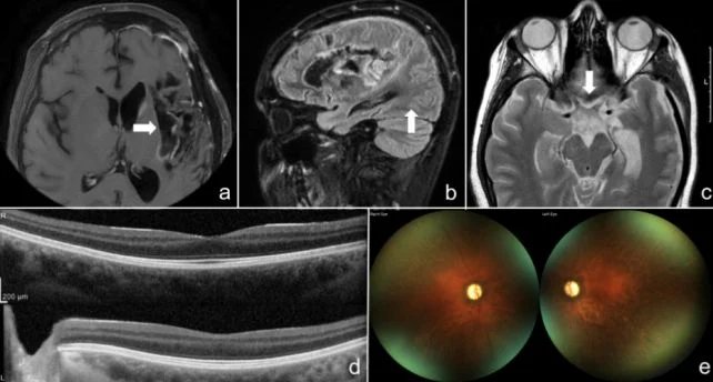 Mitochondria From a Woman's Leg Were Injected Into Her Eyes in World First