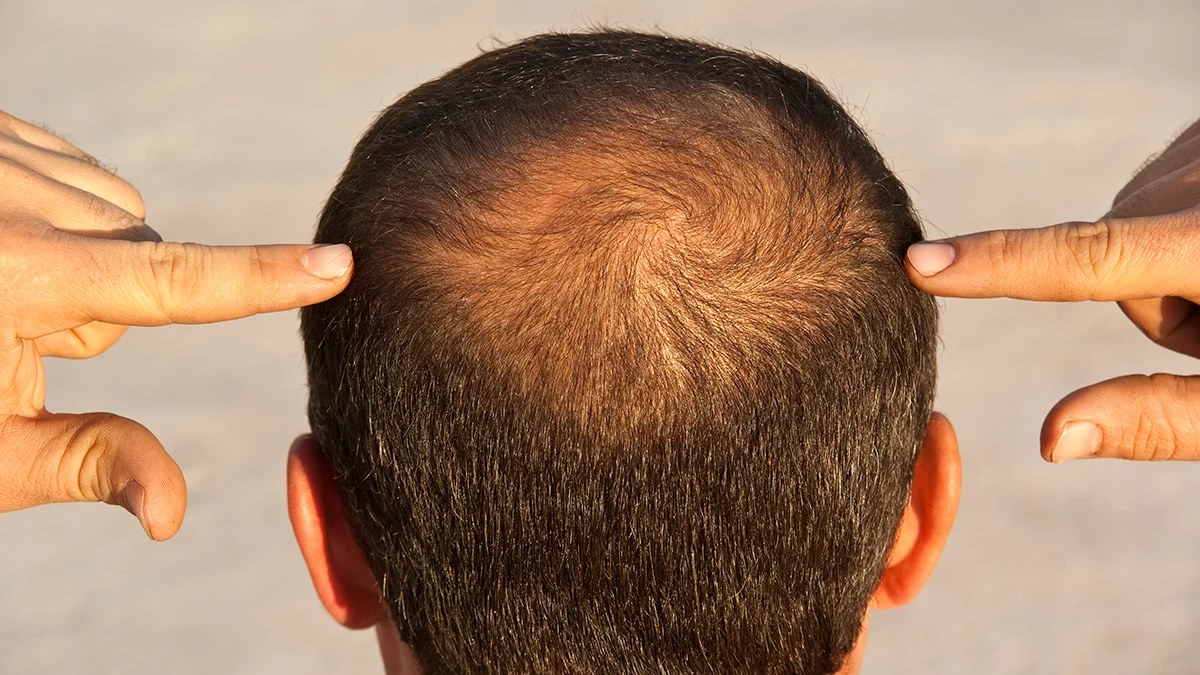 GLP-1 Drugs Could Nudge Some Men Toward Hair Loss, Study Suggests