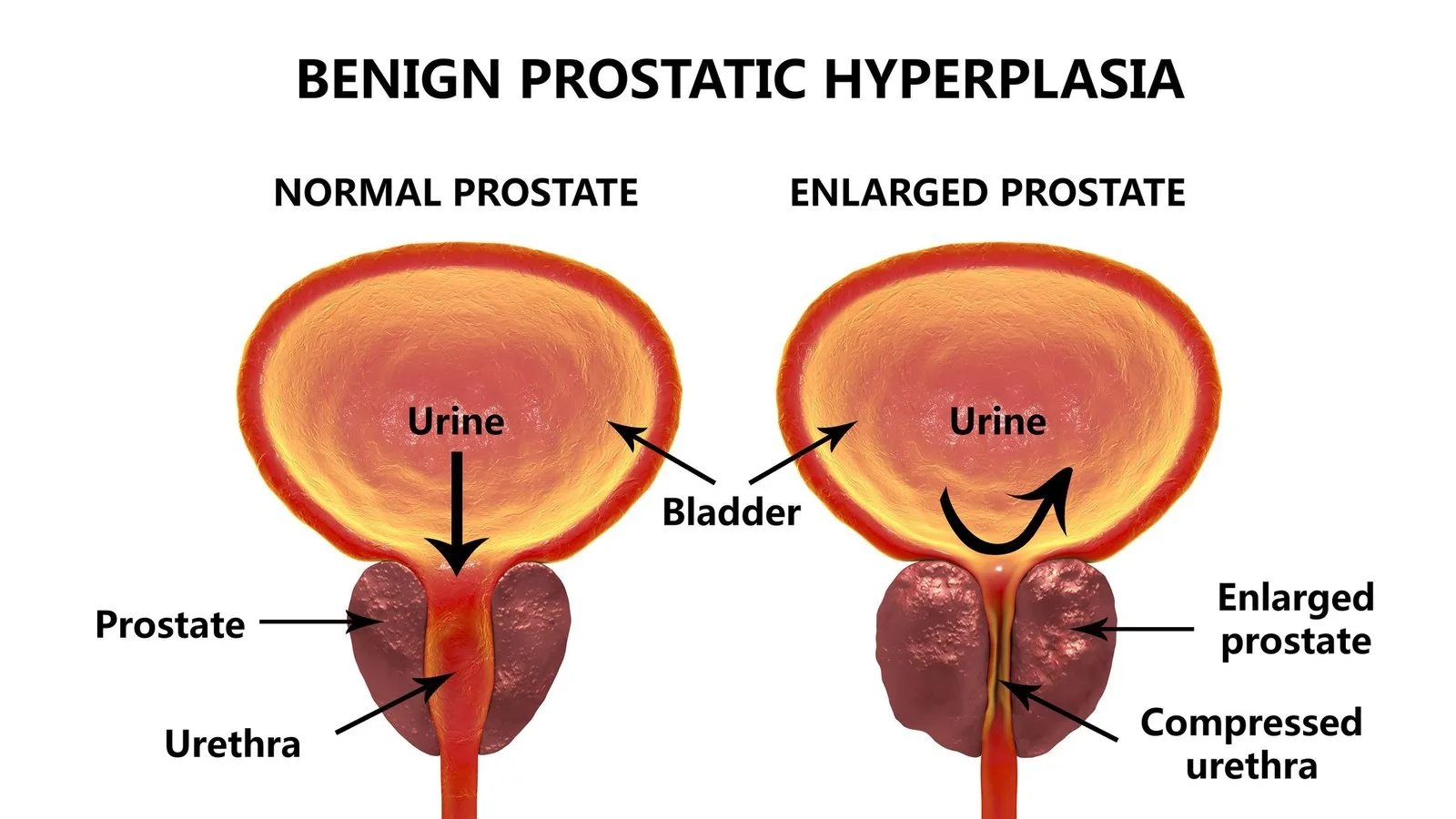 Scientists May Have Discovered Why Men's Prostates Enlarge With Age