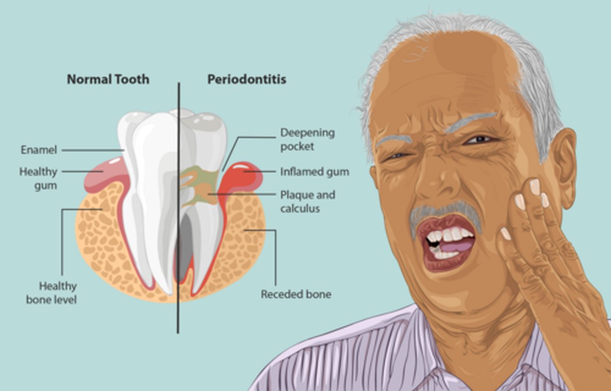 Bleeding Gums Are Linked to a 61% Higher Risk of Alzheimer's, Study Finds