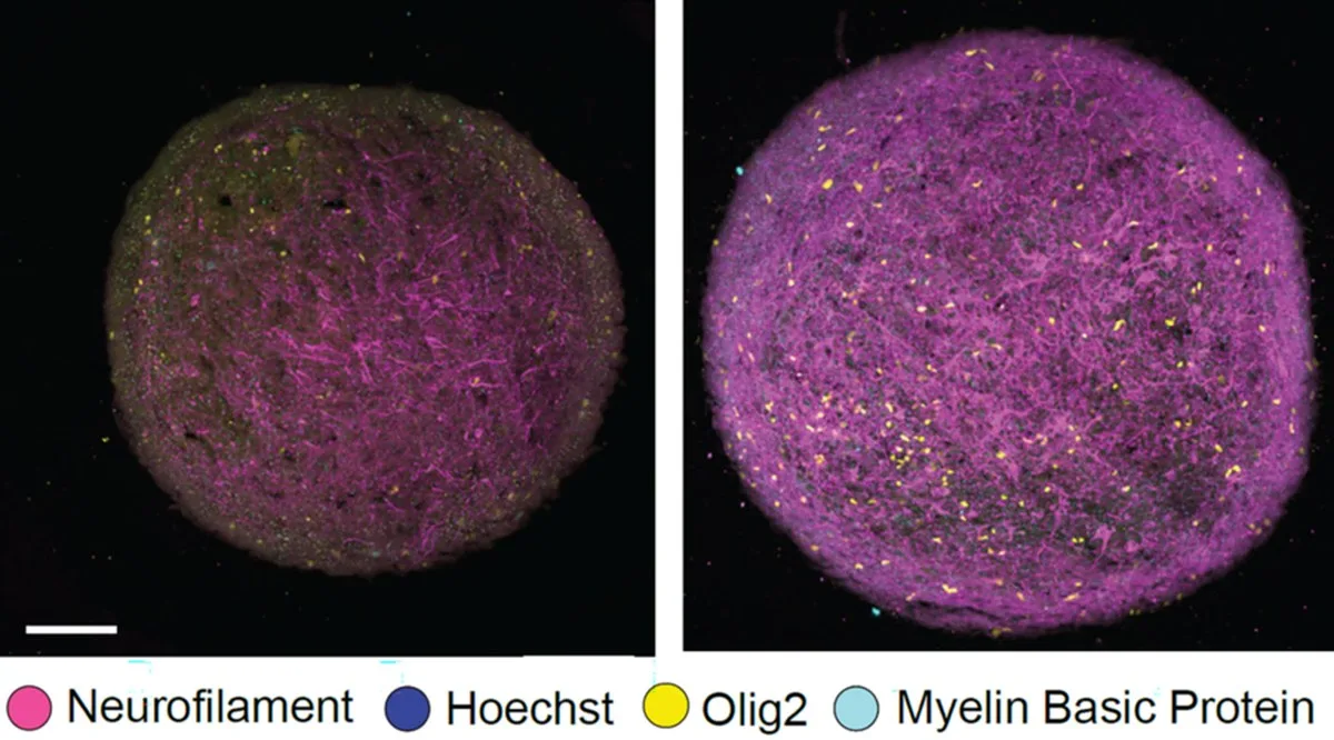 Two panels show spherical cerebral organoids, which appear as a dense tangle of magenta and cyan strands speckled with bright yellow dots. The one on the right has much more of the pink strands than the one on the left.
