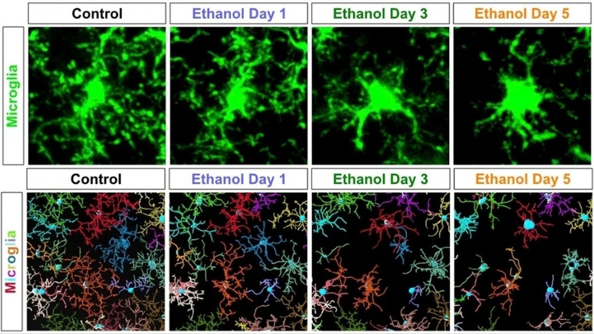 Zamanla alkol kullanımının beyindeki mikroglia bağışıklık hücrelerini olumsuz etkilediğini gösteren deneyler. (Cleveland Clinic)
