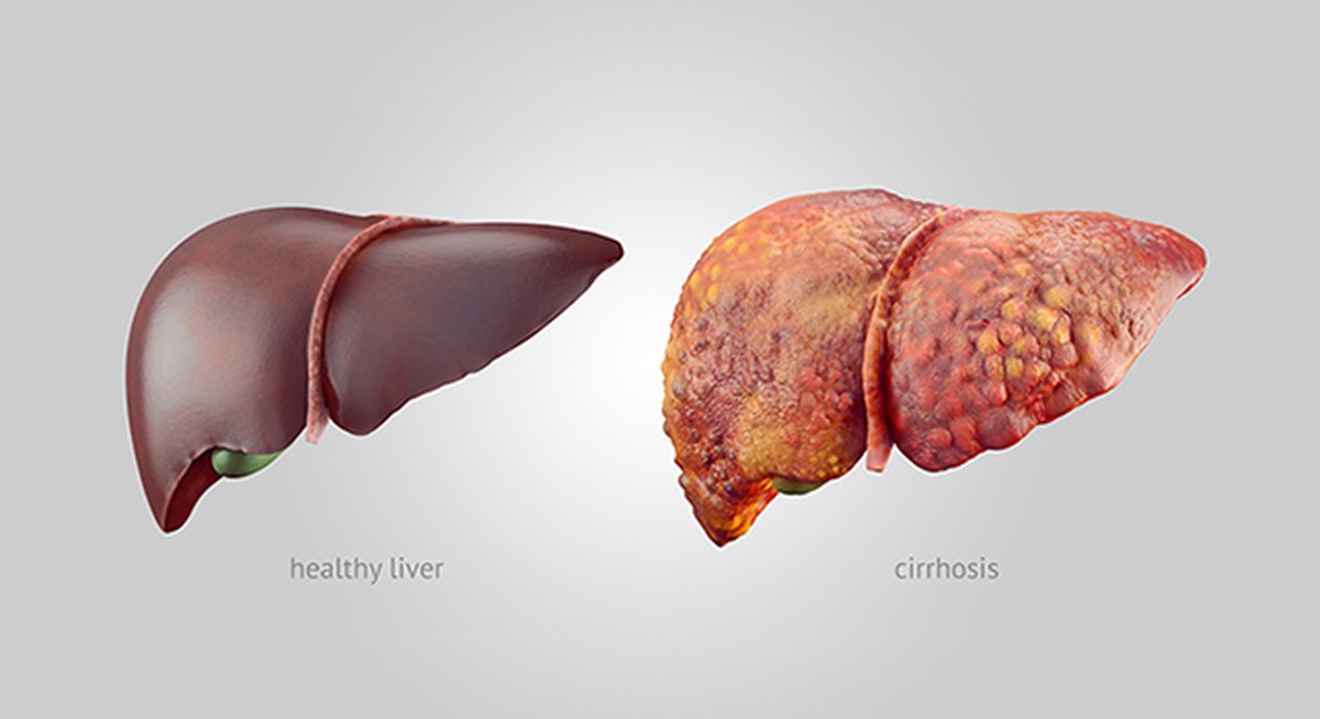 Liver disease