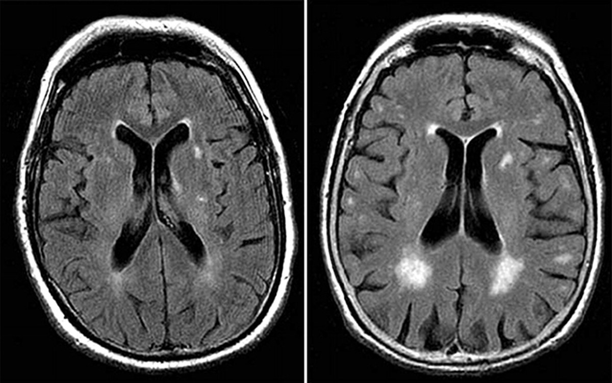 White matter hyperintensities scan